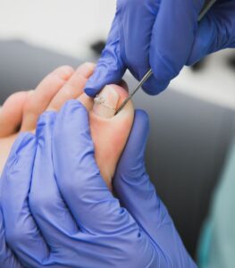 ناخن تو گوشت فرورفته: راهنمای کامل و درمان آن