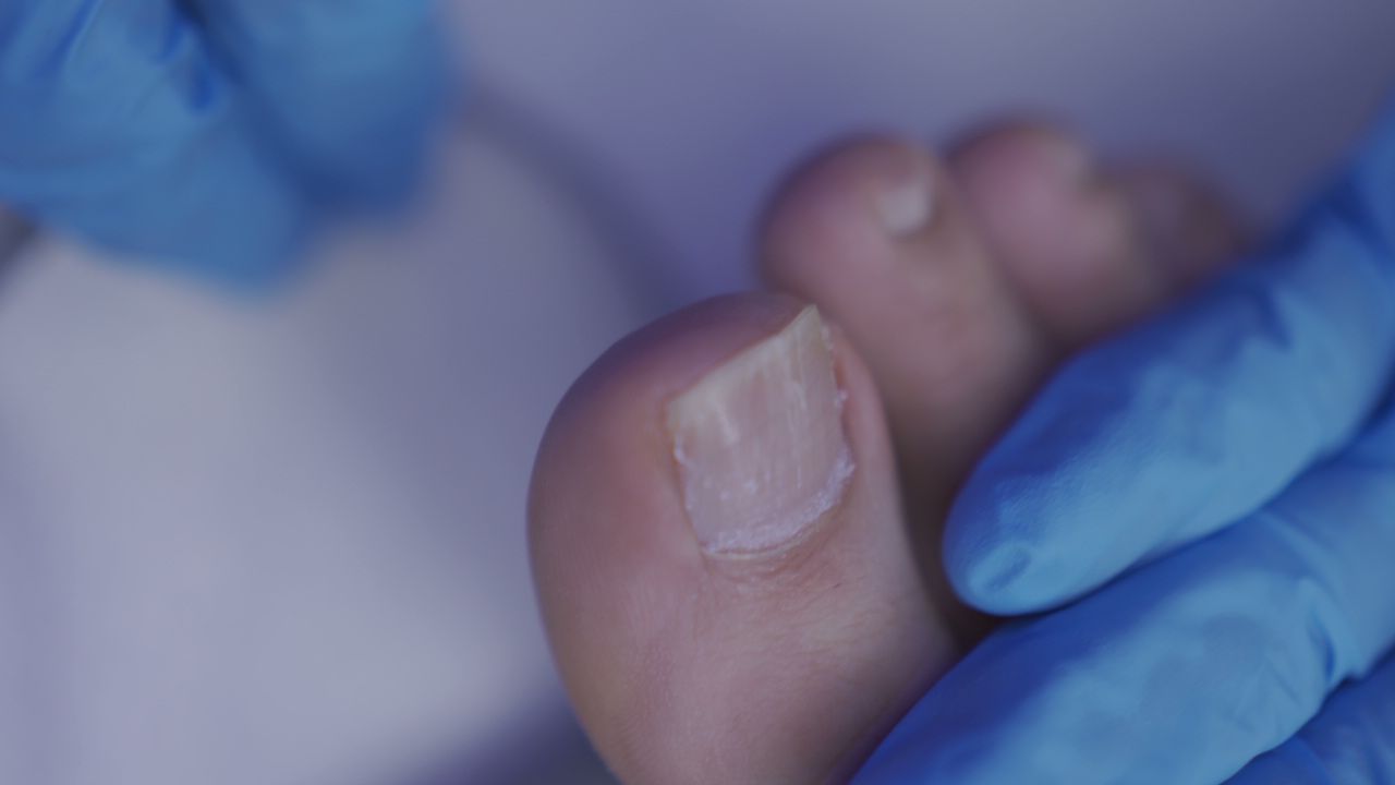 درمان تضمینی ناخن تو گوشت فرورفته-مرکز آروماتراپی آرین اسداوف