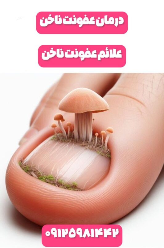 عفونت ناخن چیست؟چرا ایجاد میشود؟درمان تضمینی