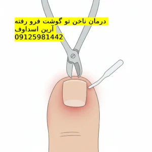 درمان ناخن فرو رفته در تهران|📞 ۰۹۱۲۵۹۸۱۴۴۲