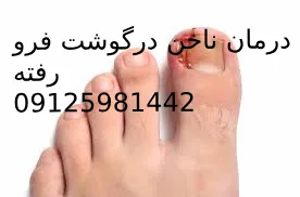 درمان ناخن تو گوشت فرورفته بدون جراحی