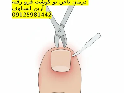 درمان ناخن فرو رفته در تهران|📞 ۰۹۱۲۵۹۸۱۴۴۲