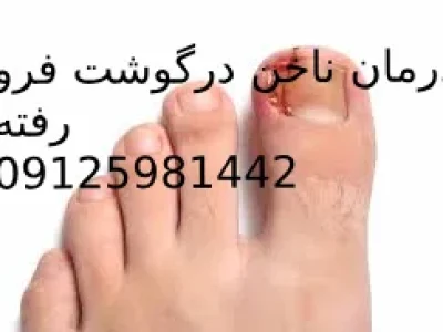 درمان ناخن تو گوشت فرورفته بدون جراحی