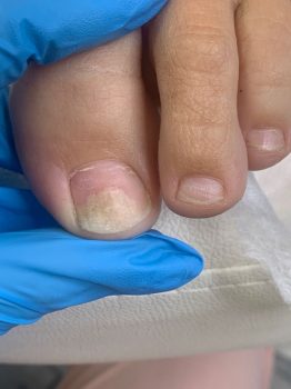 درمان قطعی عفونت ناخن پا + روش‌های سریع تخلیه عفونت