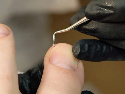 ناخن در گوشت فرو رفته