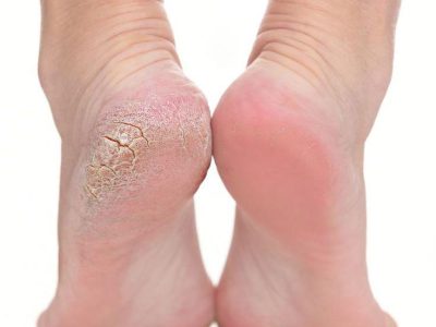 پدیکور درمنطقه22تهران